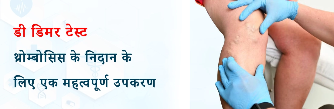 डी डिमर टेस्ट- थ्रोम्बोसिस के निदान के लिए एक महत्वपूर्ण उपकरण